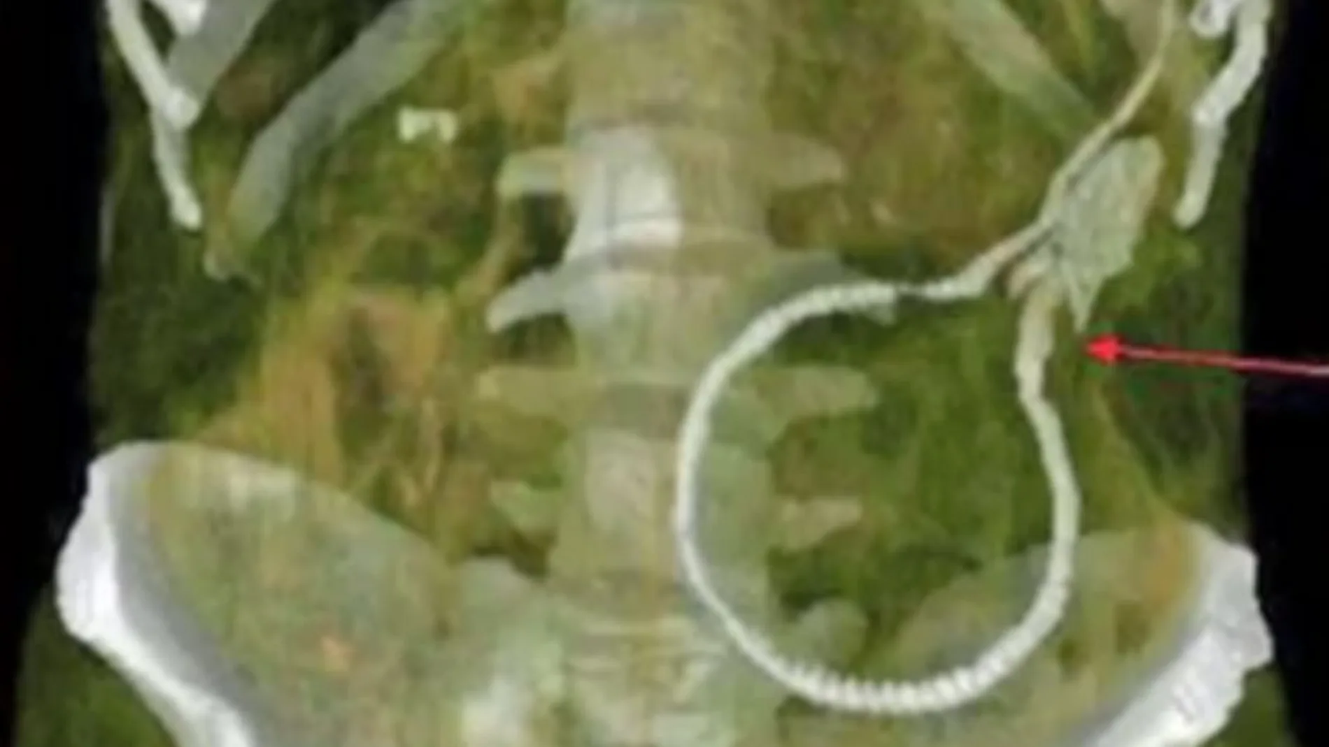 Imagen de una radiografía en la que se aprecia la anguila extirpada