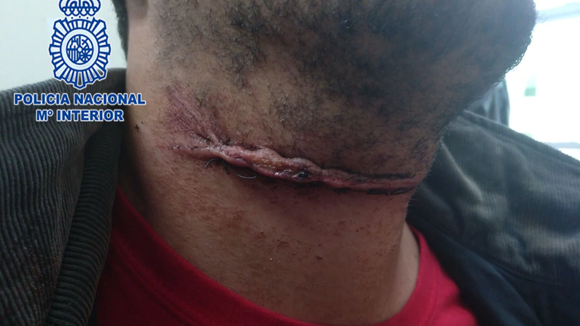 Imagen cedida por la Policía de las heridas causadas por el «gorrilla» al clavarle el cristal de una botella rota