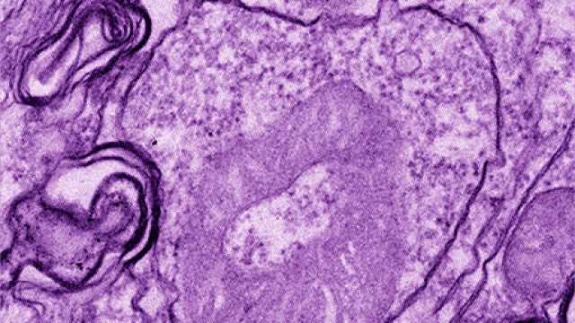 Una célula cancerígena