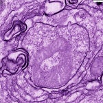Una célula cancerígena