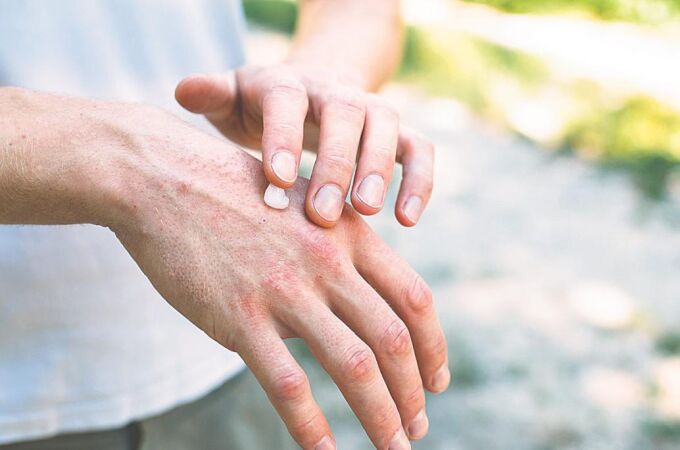 La dermatitis atópica, un riesgo para la salud mental 