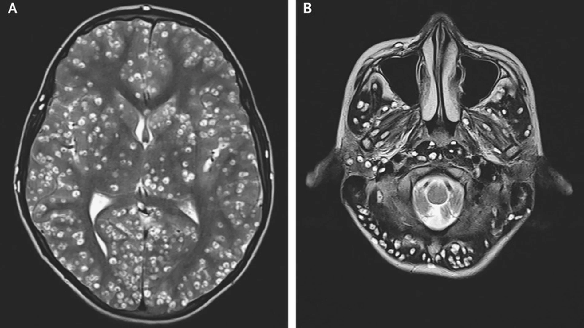 Imagen del cerebro afectado