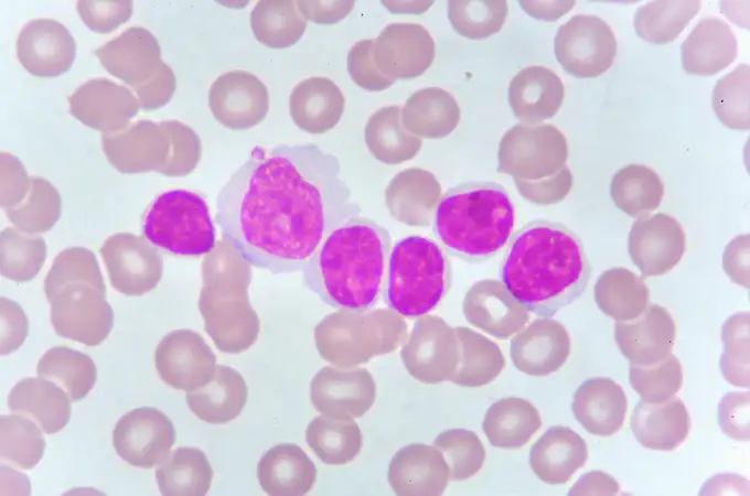 Una nueva forma de detectar y destruir células madre de la leucemia