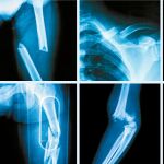 Expertos alertan de que dejar de tomar denosumab incrementa el riesgo de fracturas