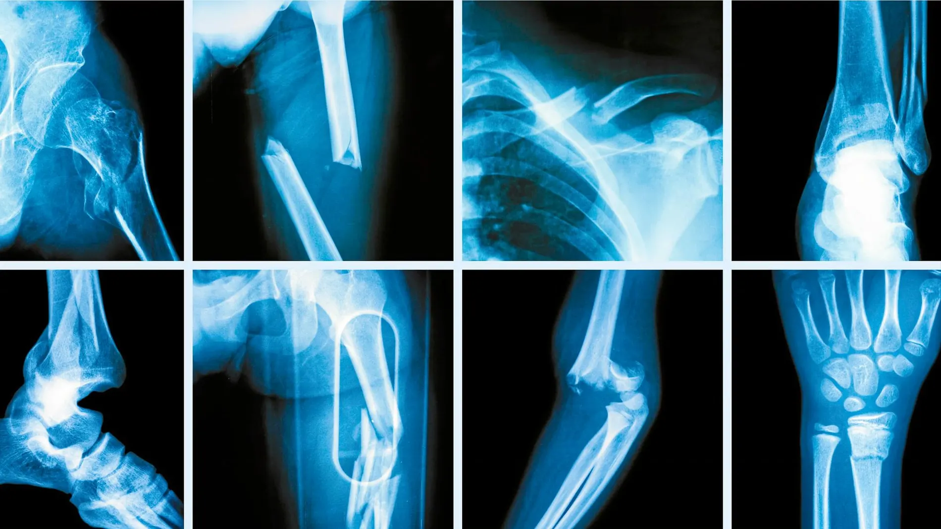 Expertos alertan de que dejar de tomar denosumab incrementa el riesgo de fracturas