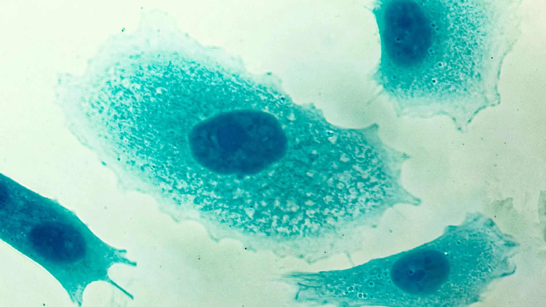 Células de un cáncer de próstata vistas al microscopio