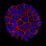 El cáncer de páncreas visto al microscopio