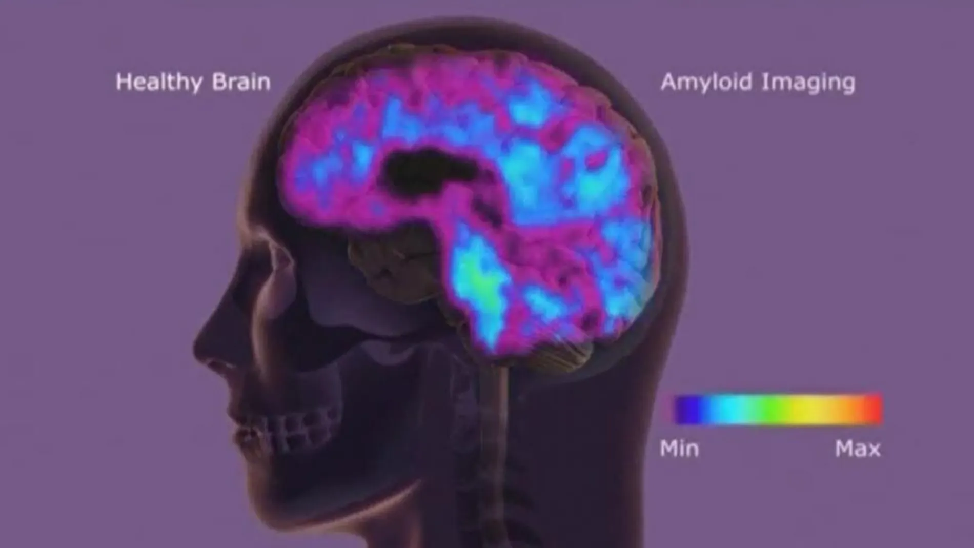 Un fármaco experimental podría curar el Alzheimer