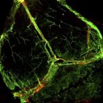 Linfedema (I)