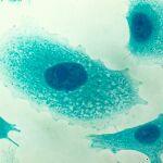 Células del cáncer de próstata vistas al microscopio / Dreamstime