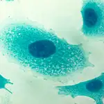 Células del cáncer de próstata vistas al microscopio / Dreamstime