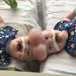 Unas gemelas unidas por la cabeza, separadas en su primer cumpleaños