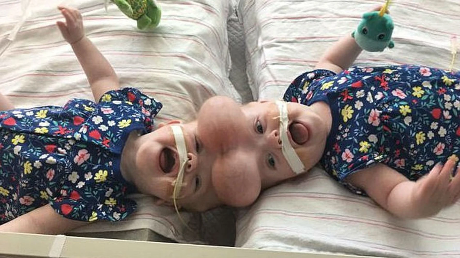 Unas gemelas unidas por la cabeza, separadas en su primer cumpleaños