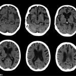 ¿Puede contagiarse el alzheimer?