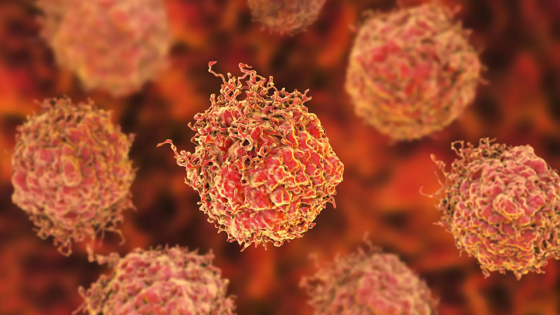 Biopsia fusión: el último avance diagnóstico del cáncer de próstata