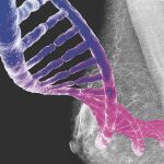 Cuando se lleva el cáncer de mama en los genes