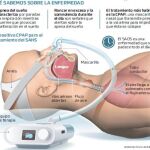 Tratamiento de la apnea del sueño a través de la corrección mandibular