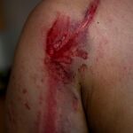 Herida en un brazo
