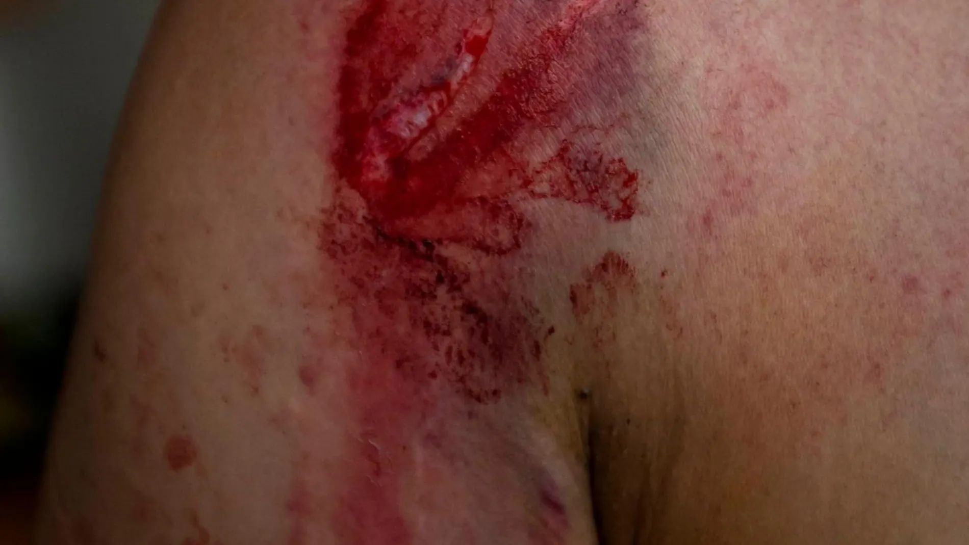 Herida en un brazo