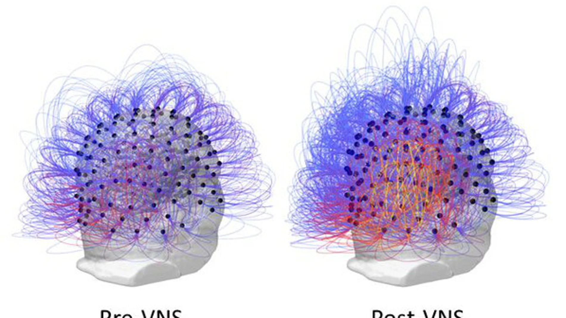 Flujo de información a través de los electrodos antes y después de la estimulación del nervio vago (a la derecha, post-VNS). A la derecha, los colores cálidos (amarillo y rojo) indican un aumento en la conectividad entre las regiones parietales posteriores. / Corazzol et al.