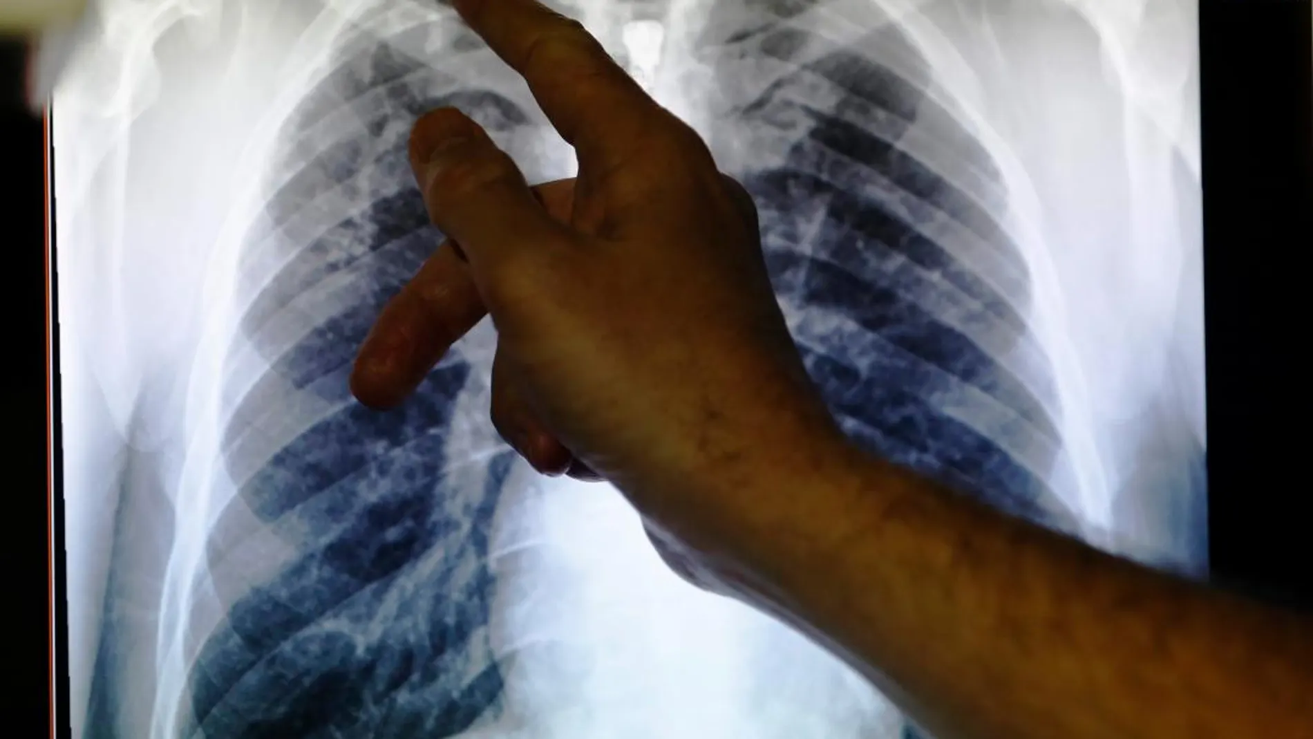 Radiografía de unos pulmones afectados por tuberculosis / Reuters
