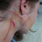 Imagen de las secuelas que dejó la paliza en la joven monitora agredida