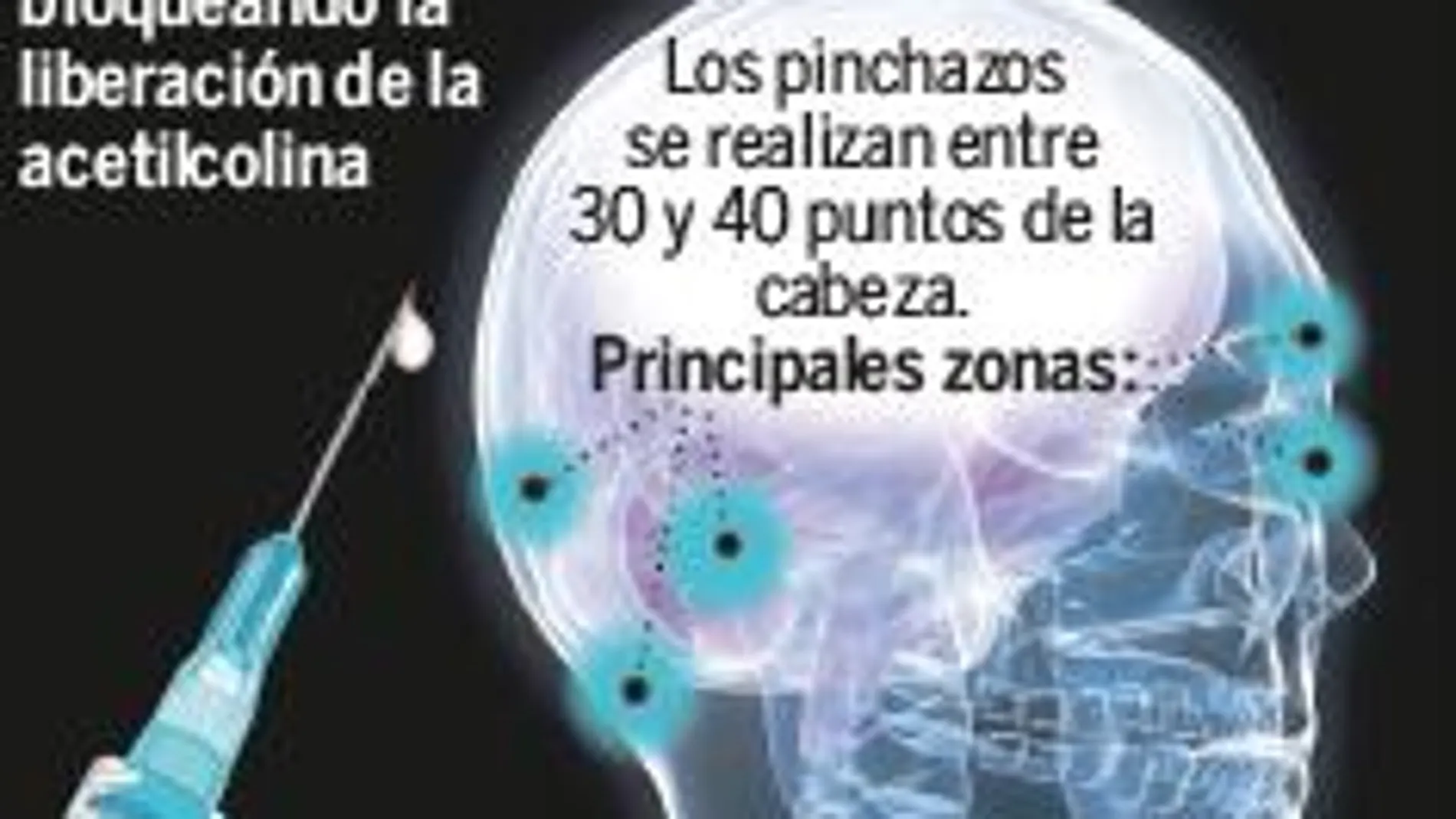 El «Botox» reduce hasta un 50% los síntomas de la migraña crónica