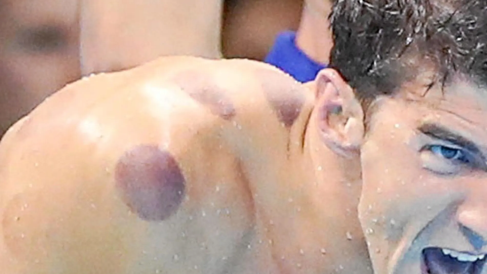 Las llamativas manchas en el cuerpo que lucía Michael Phelps
