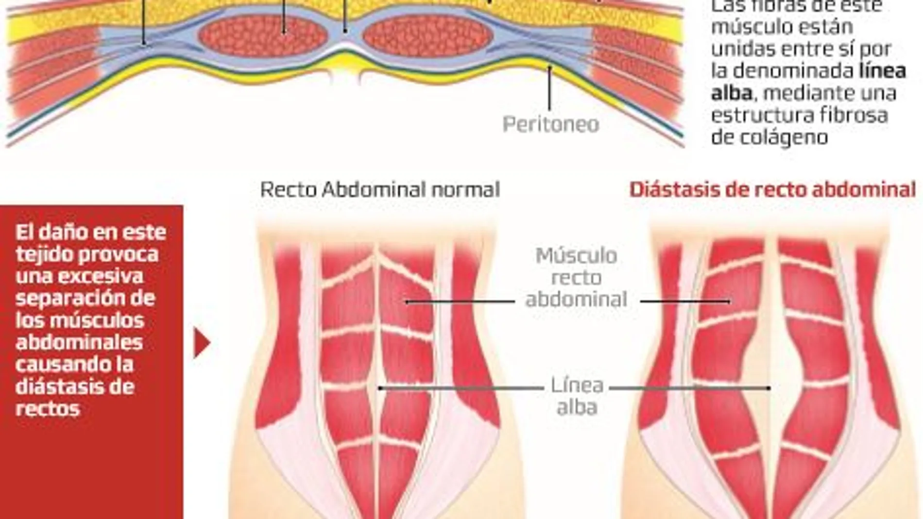 Laparoscopia contra la distensión abdominal