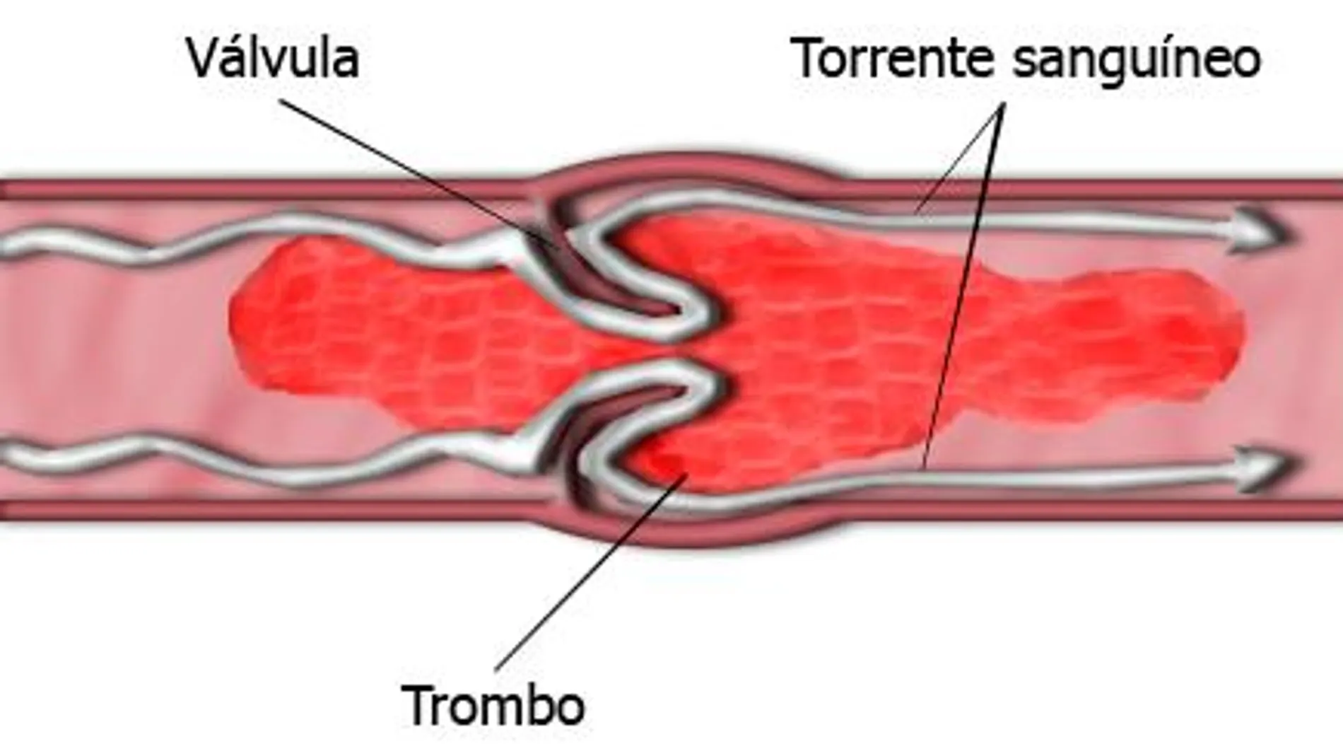 Trombofilia