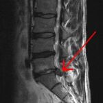 Hernia discal