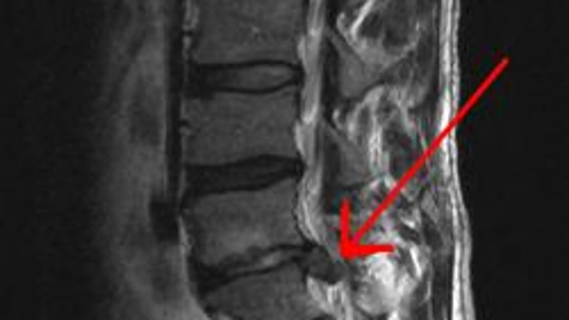 Hernia discal