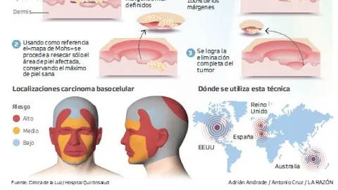 Cirugía de Mohs, extirpar tumores de la piel con precisión