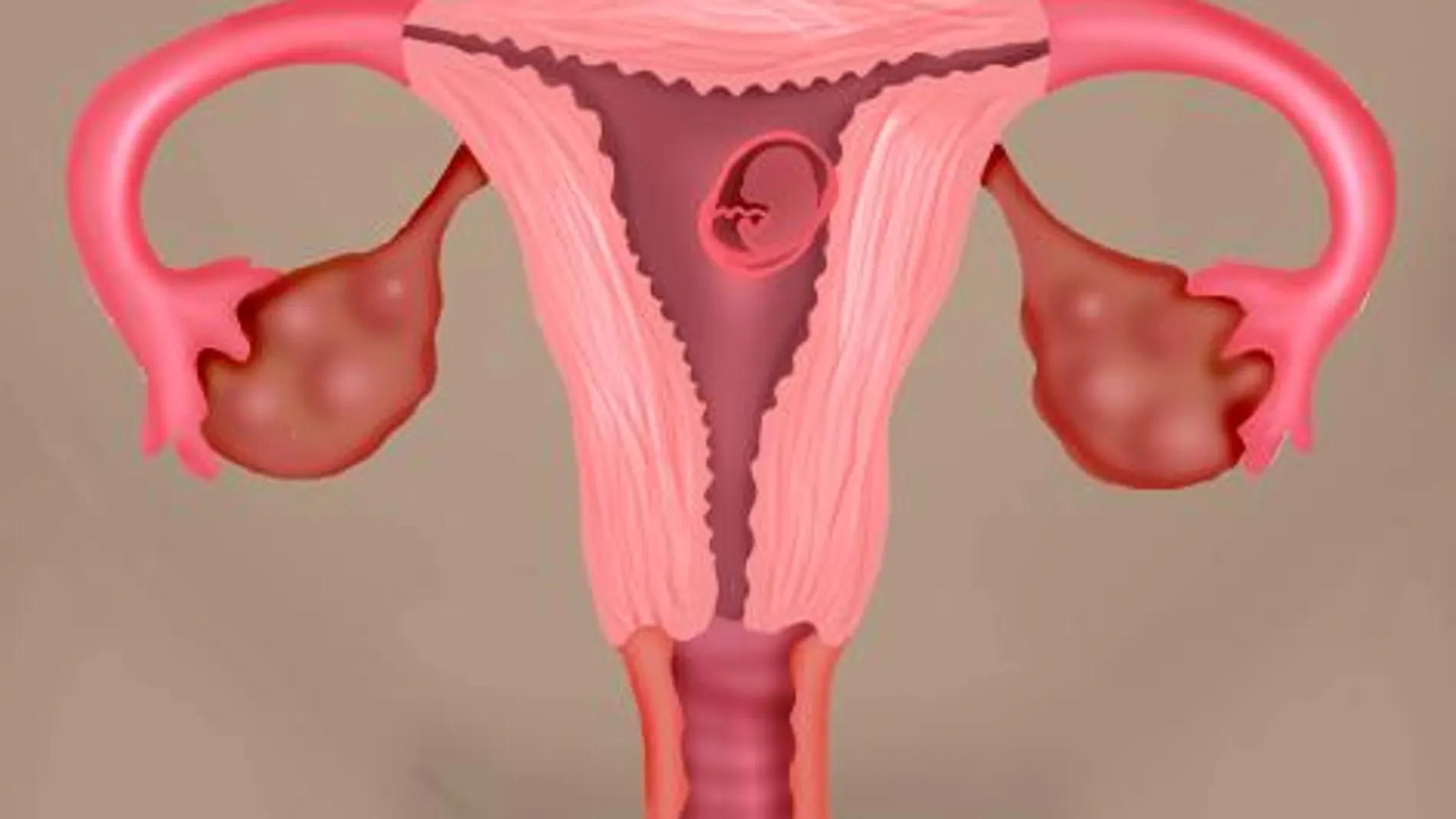 La calidad quirúrgica marca el pronóstico en cáncer de ovario