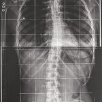 Doctor, ¿debo operarme de la columna?