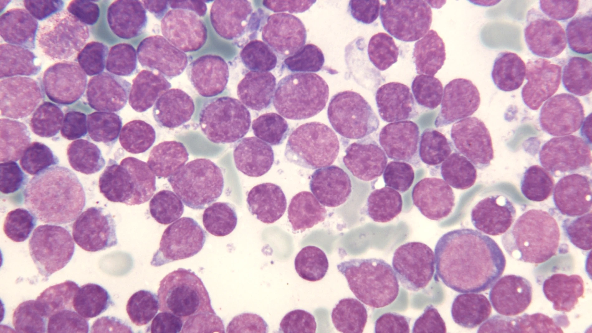 Células leucémicas