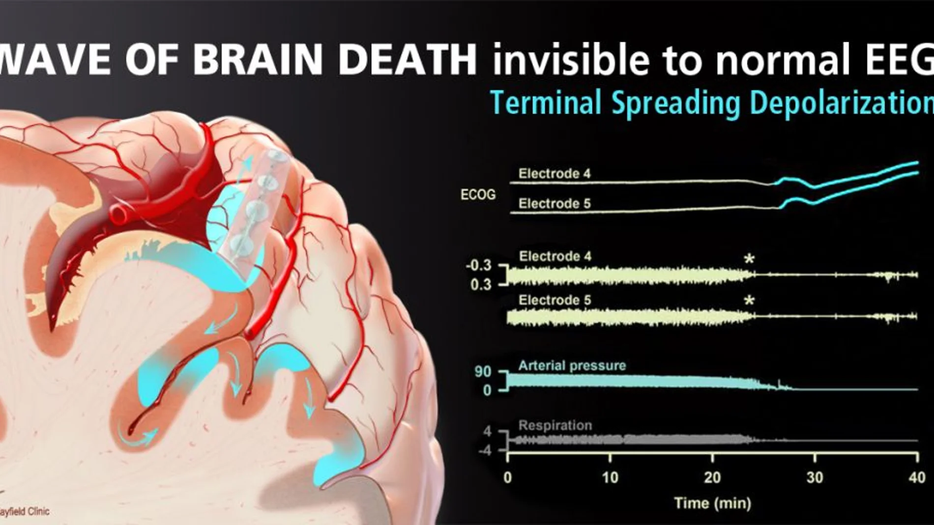Tsunami cerebral: la despolarización por difusión terminal ocurre varios minutos después de que la ecografía muestra silencio eléctrico (asteriscos) y el paro circulatorio y la respiración han terminado