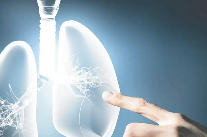 Golpe al cáncer de pulmón más agresivo: un nuevo fármaco revienta el tumor desde dentro
