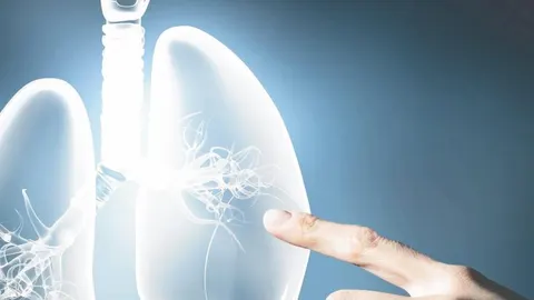 Cáncer de Pulmón: las nuevas terapias ya suman años de vida