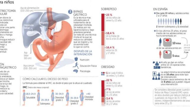 Cirugía para niños obesos: 15 reducen su estómago cada año