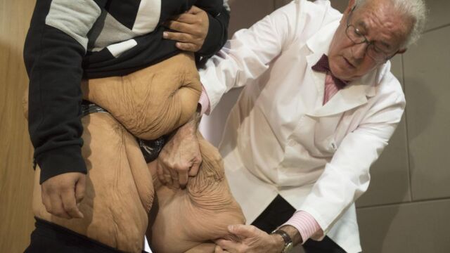 El doctor Carlos Ballesta mostrando hoy en el Hospital Inmaculada de Granada el marcaje para eliminar cerca de 40 kilos de colgajos cutáneos de piel y grasa sobrantes en abdomen, glúteos, brazos y nalgas de Juan Manuel Heredia/ Fotos: Efe
