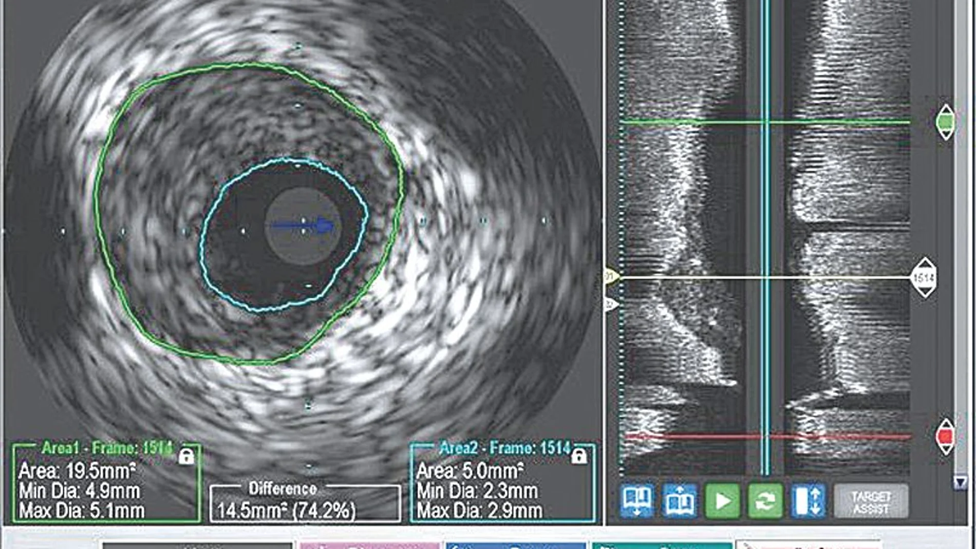 Las imágenes recogidas configuran mapas visuales que permiten al clínico guiar los instrumentos a través del cuerpo