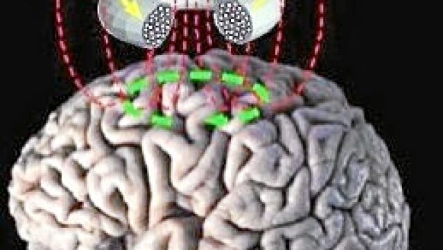 Estimulación magnética transcraneal (TMS)