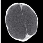 Los ventrículos cerebrales del bebé de la imagen estaban llenos de líquido cerebroespinal que no ha sido capaz de drenar