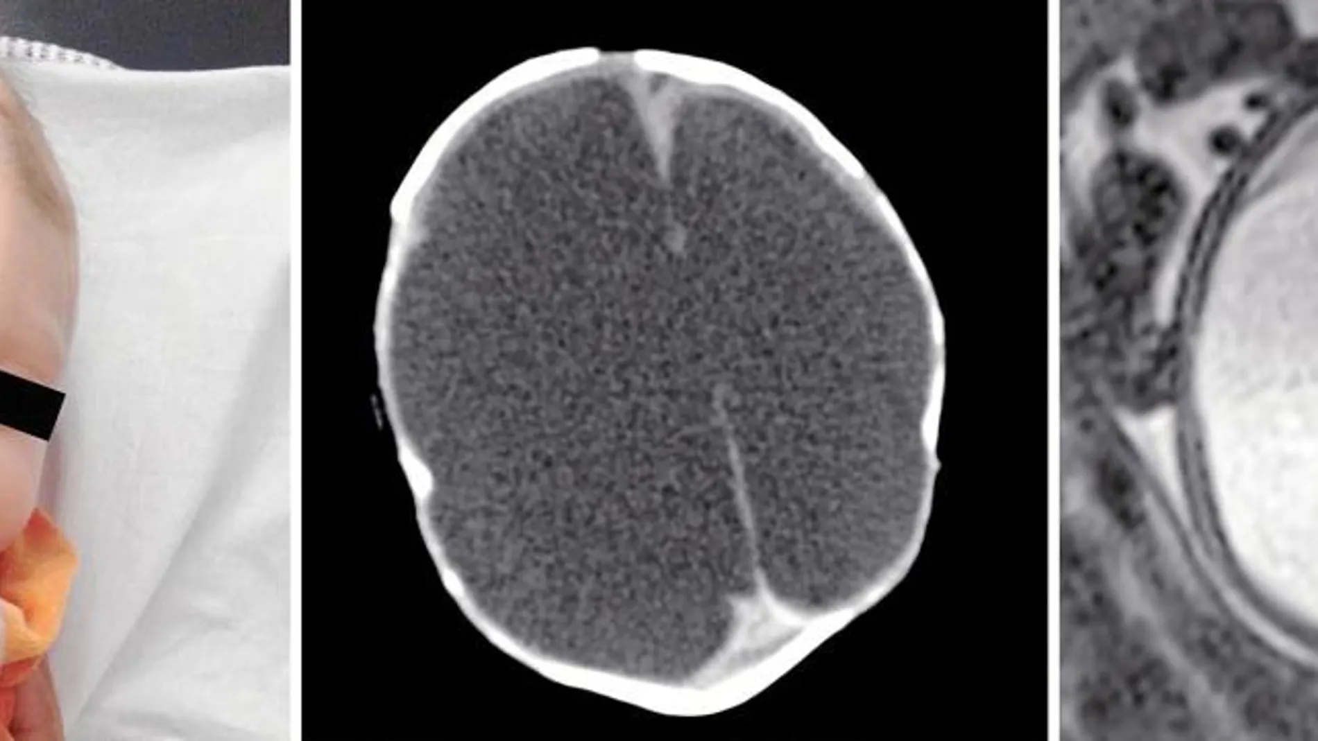 Los ventrículos cerebrales del bebé de la imagen estaban llenos de líquido cerebroespinal que no ha sido capaz de drenar