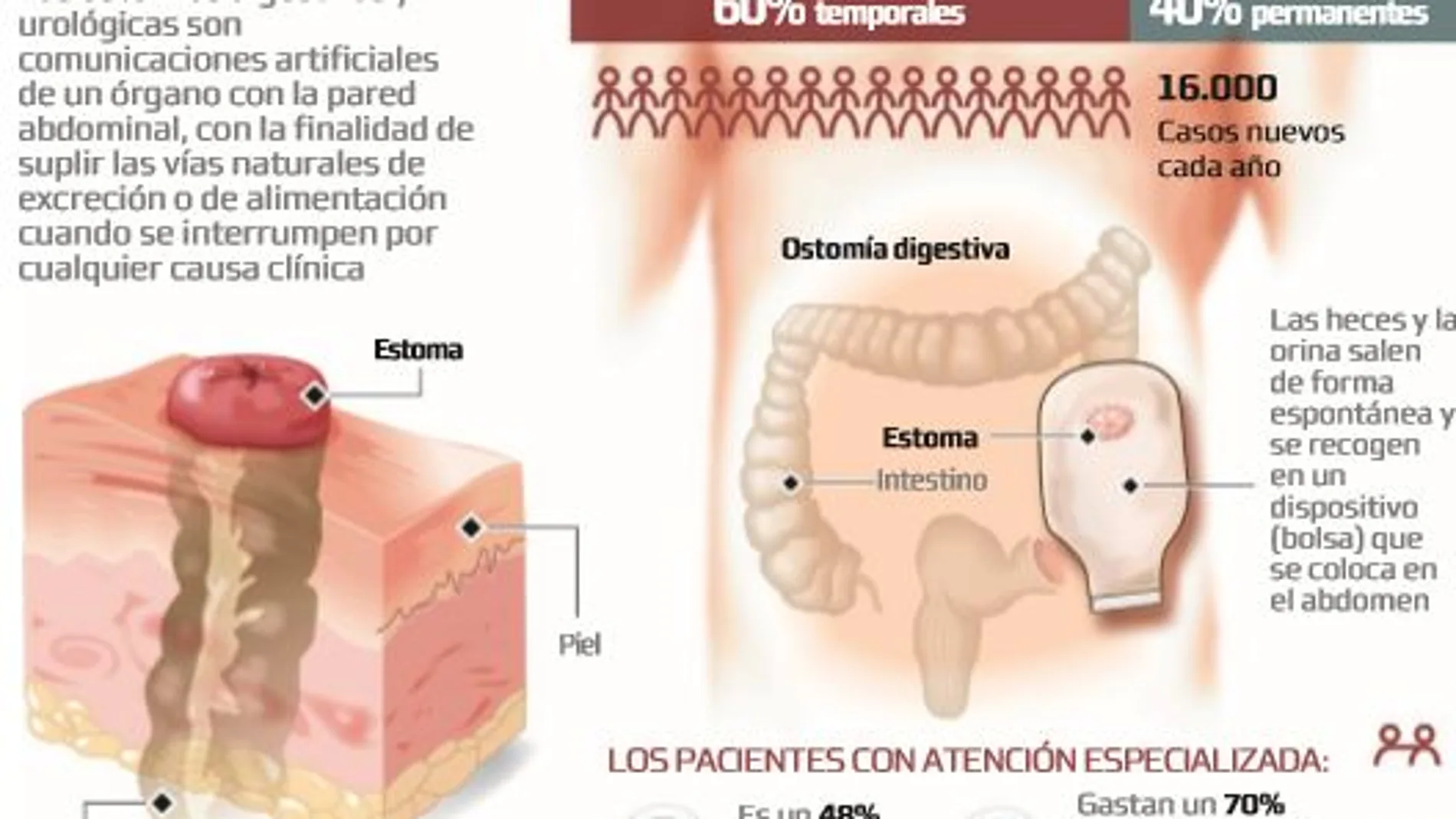 Sólo seis autonomías cumplen el ratio ideal de estomaterapeutas