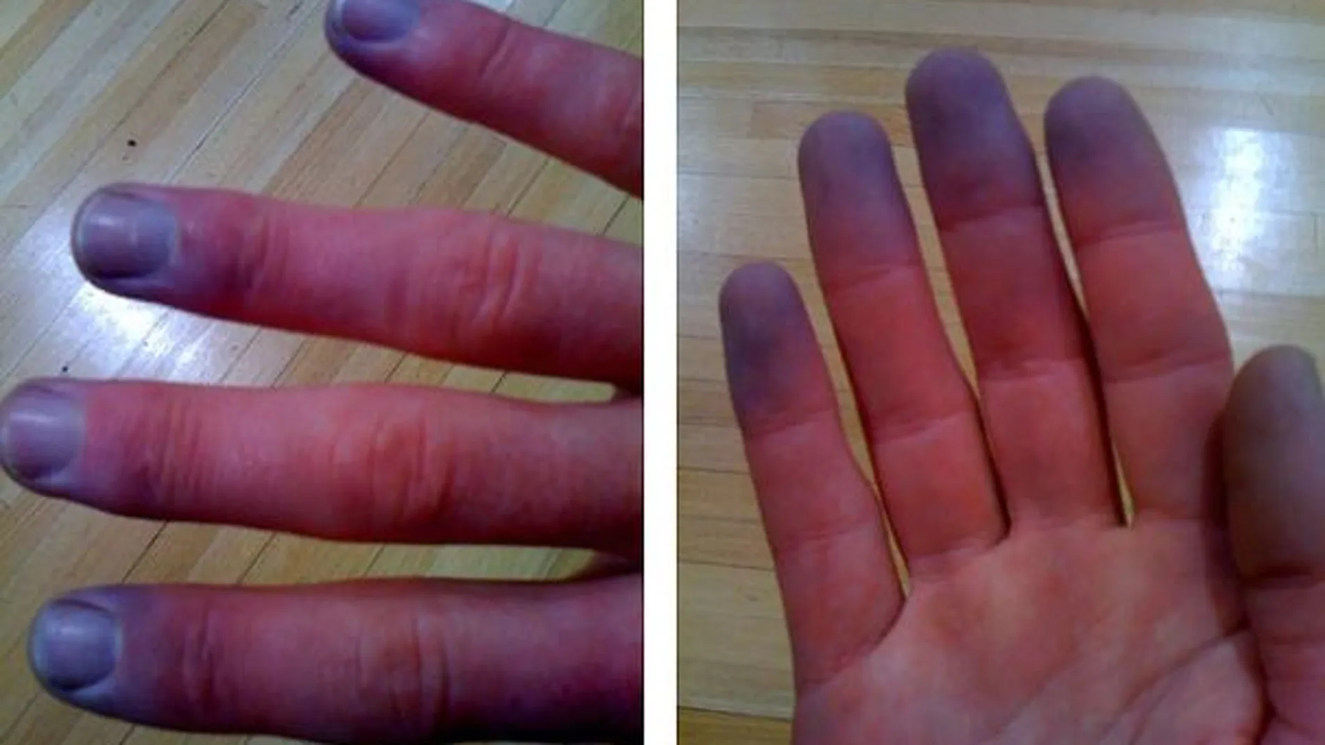 Síndrome de Raynaud