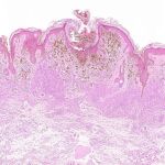 Imagen de un melanoma