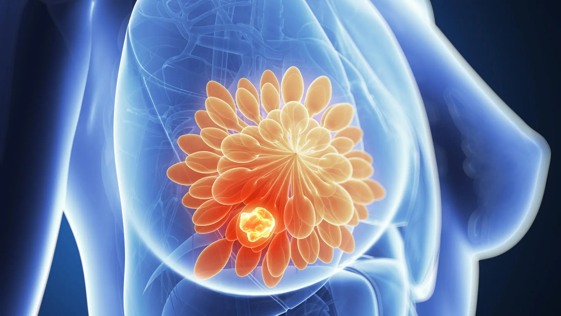Se trata del tumor más agresivo y representa, aproximadamente, entre el 10% y el 15% de todos los cánceres de mama