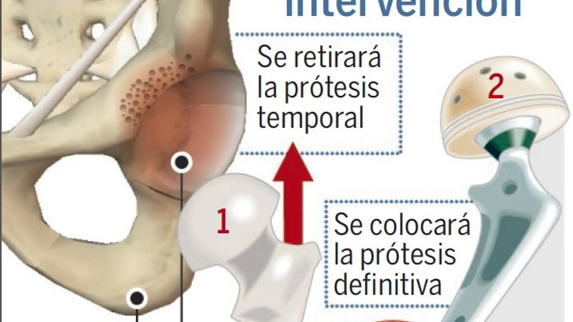 Una intervención más sencilla